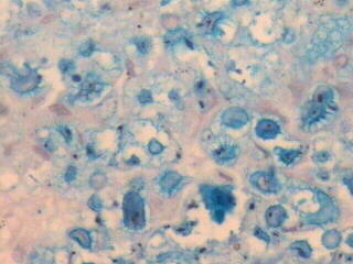 Cryptococcus (Alcian Blue Stain) - <div style=